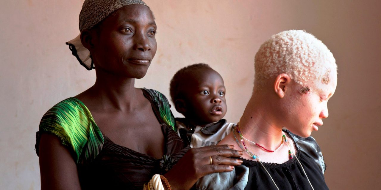 El Papa lanza la campaña «Help african albinos»