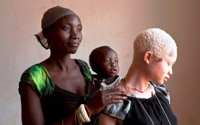 El Papa lanza la campaña «Help african albinos»
