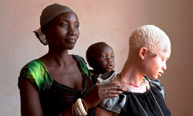 El Papa lanza la campaña «Help african albinos»