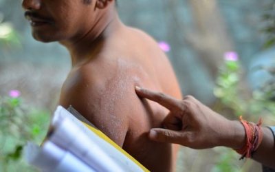 Urge rescatar la dignidad de los enfermos de lepra